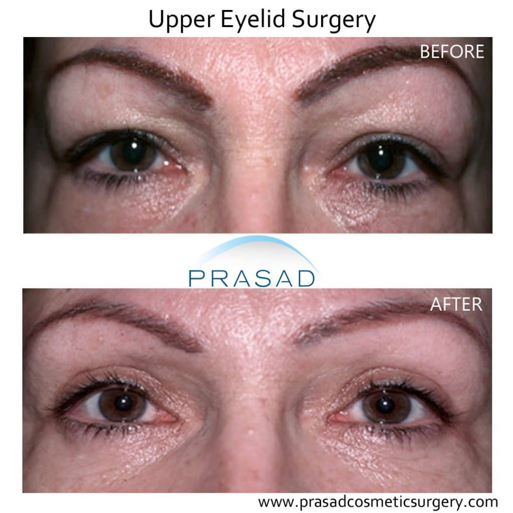 best eye cosmetic surgeon