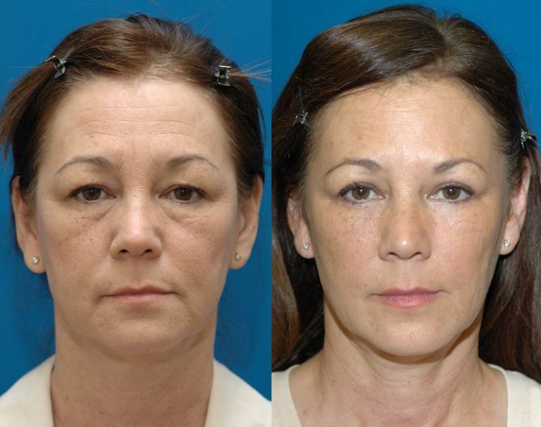 Best eye cosmetic surgeon: Choosing an expert for delicate procedures