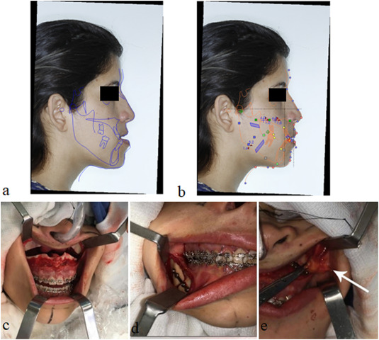 bimax surgery