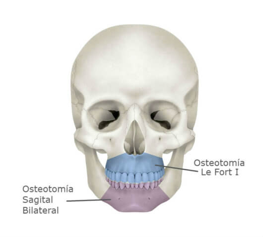 bimax surgery