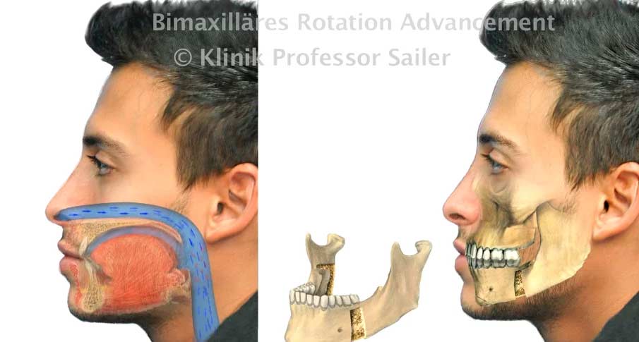 bimax surgery