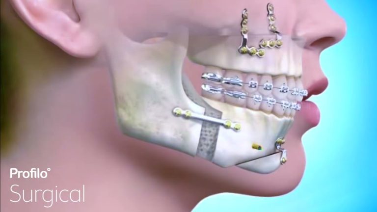 Bimax Surgery: Reshaping the jaw
