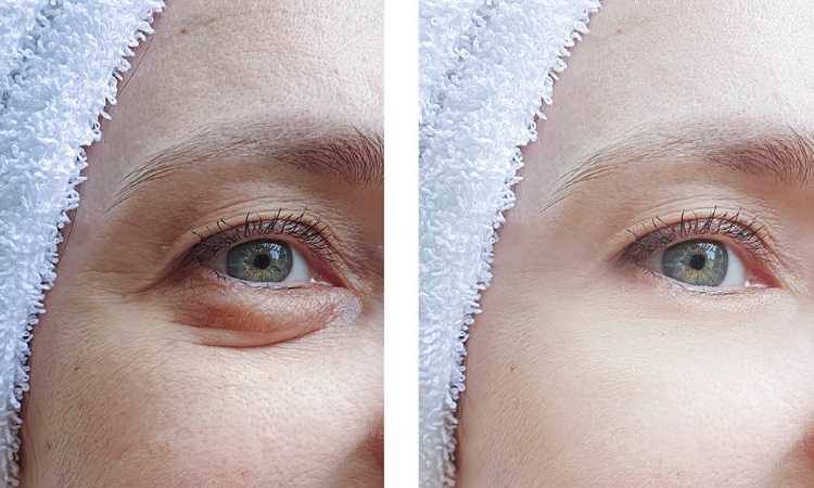 blepharoplasty price blepharoplasty price