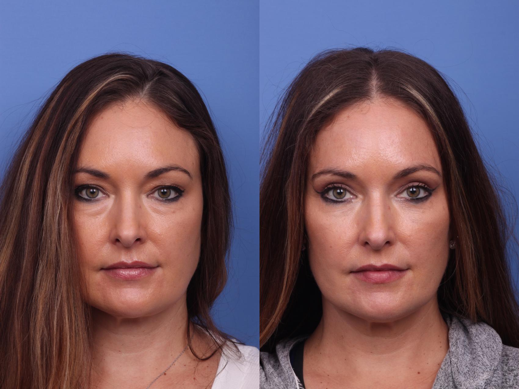 blepharoplasty price blepharoplasty price