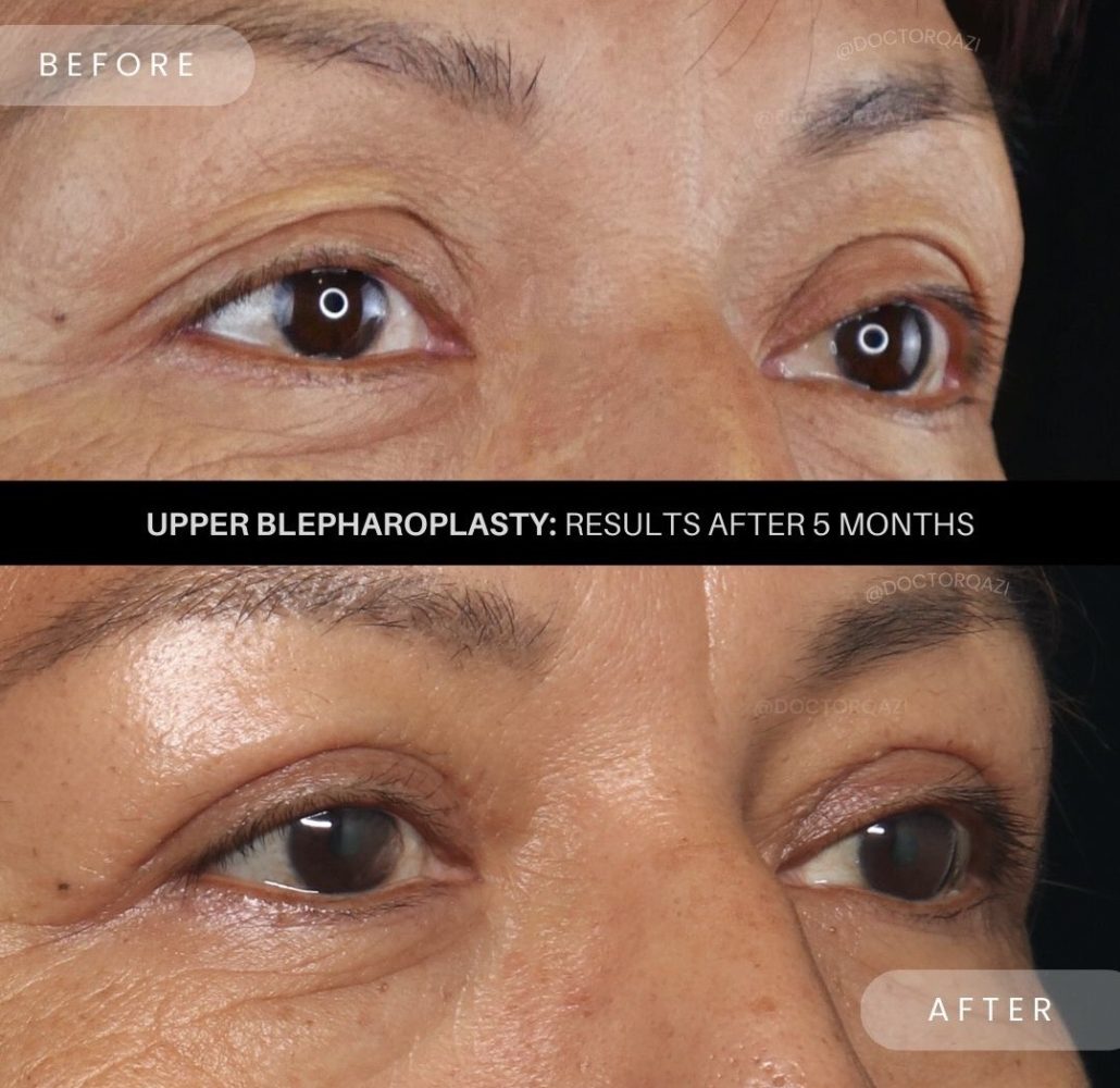 blepharoplasty price blepharoplasty price