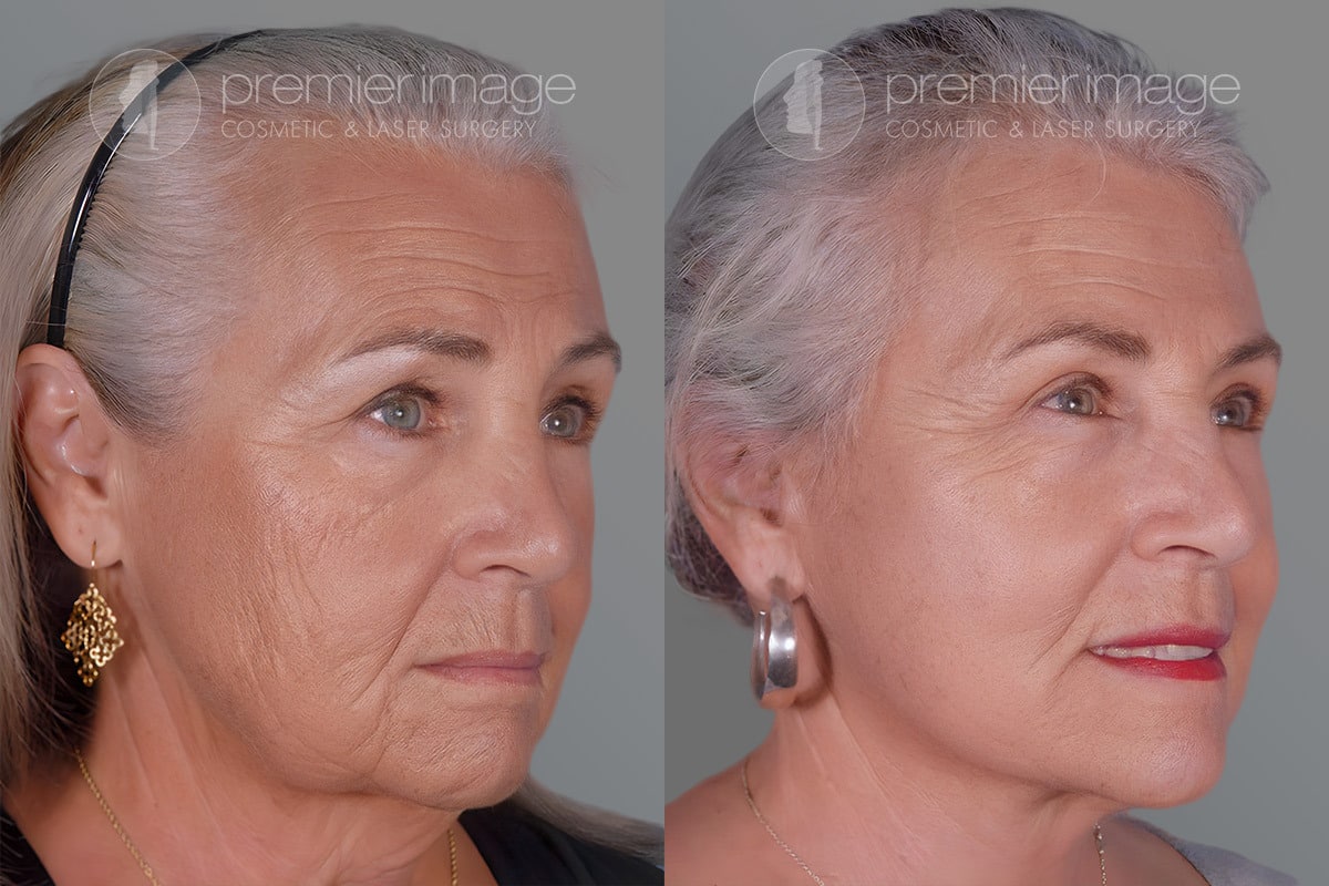 blepharoplasty blepharoplasty