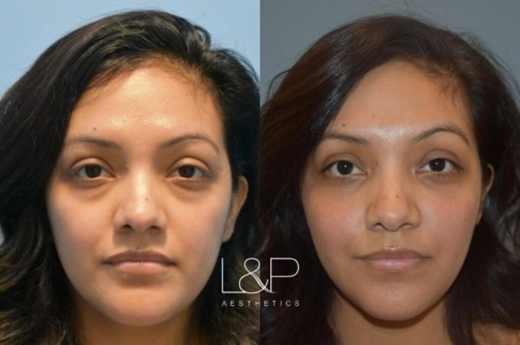 blepharoplasty blepharoplasty