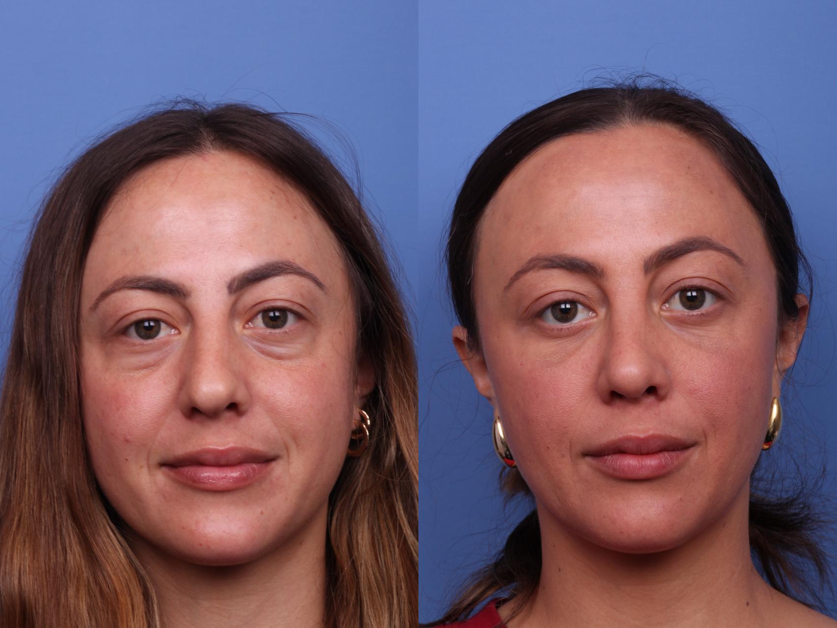 blepharoplasty blepharoplasty