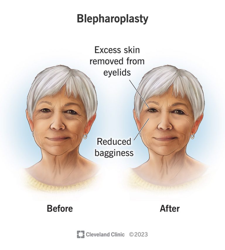 Blepharoplasty: Revitalizing the eyes with precision
