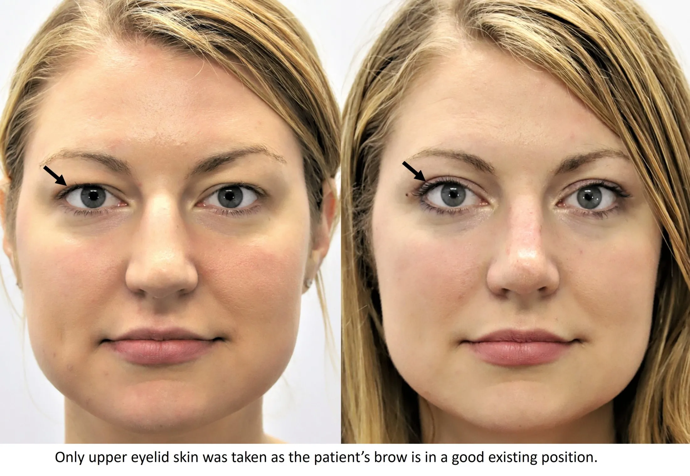 blepharoplasty blepharoplasty