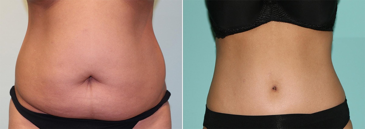 body contouring surgery
