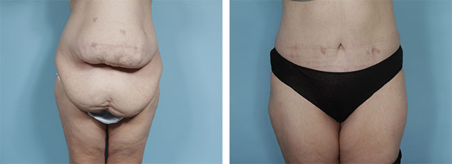 Body contouring surgery: Shaping your ideal silhouette