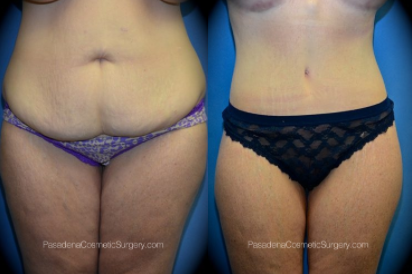 body contouring surgery