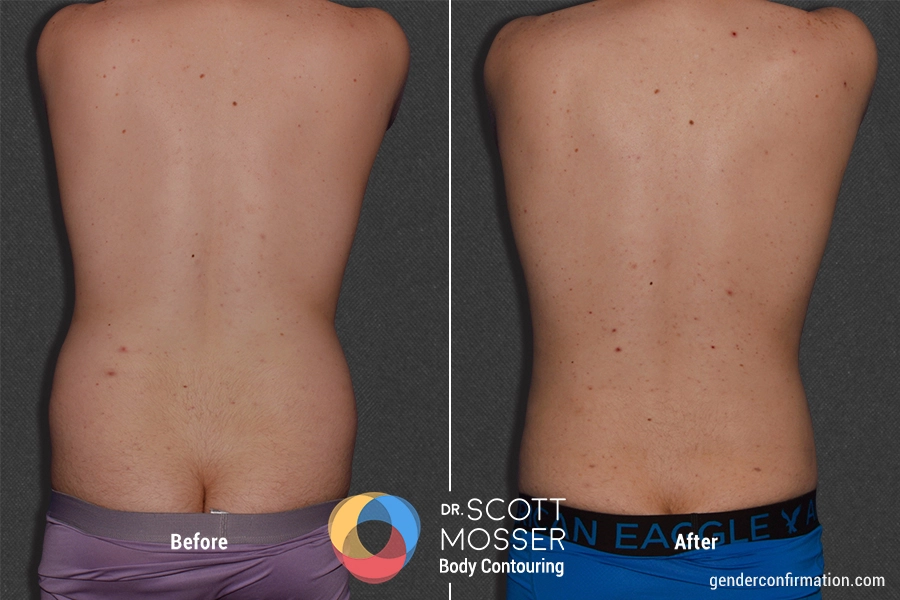body contouring surgery