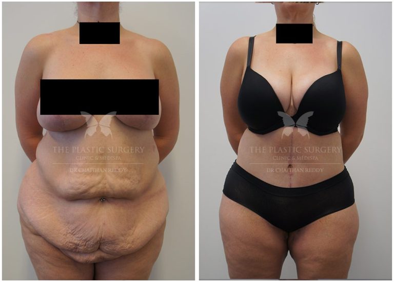 Body plastic surgery: Comprehensive solutions for transformation