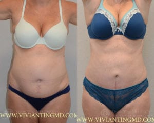 bodytite breast lift bodytite breast lift