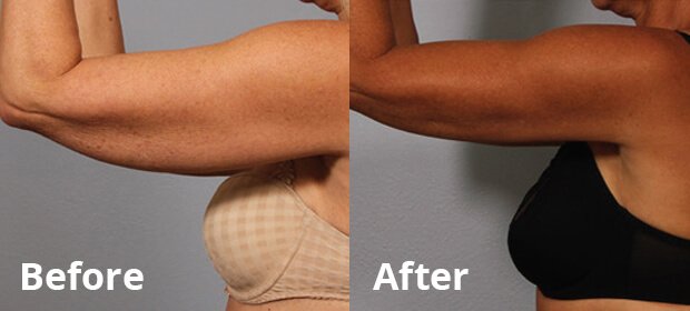 bodytite breast lift bodytite breast lift