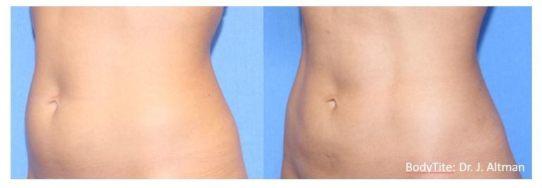 BodyTite Cost: Skin tightening and fat reduction
