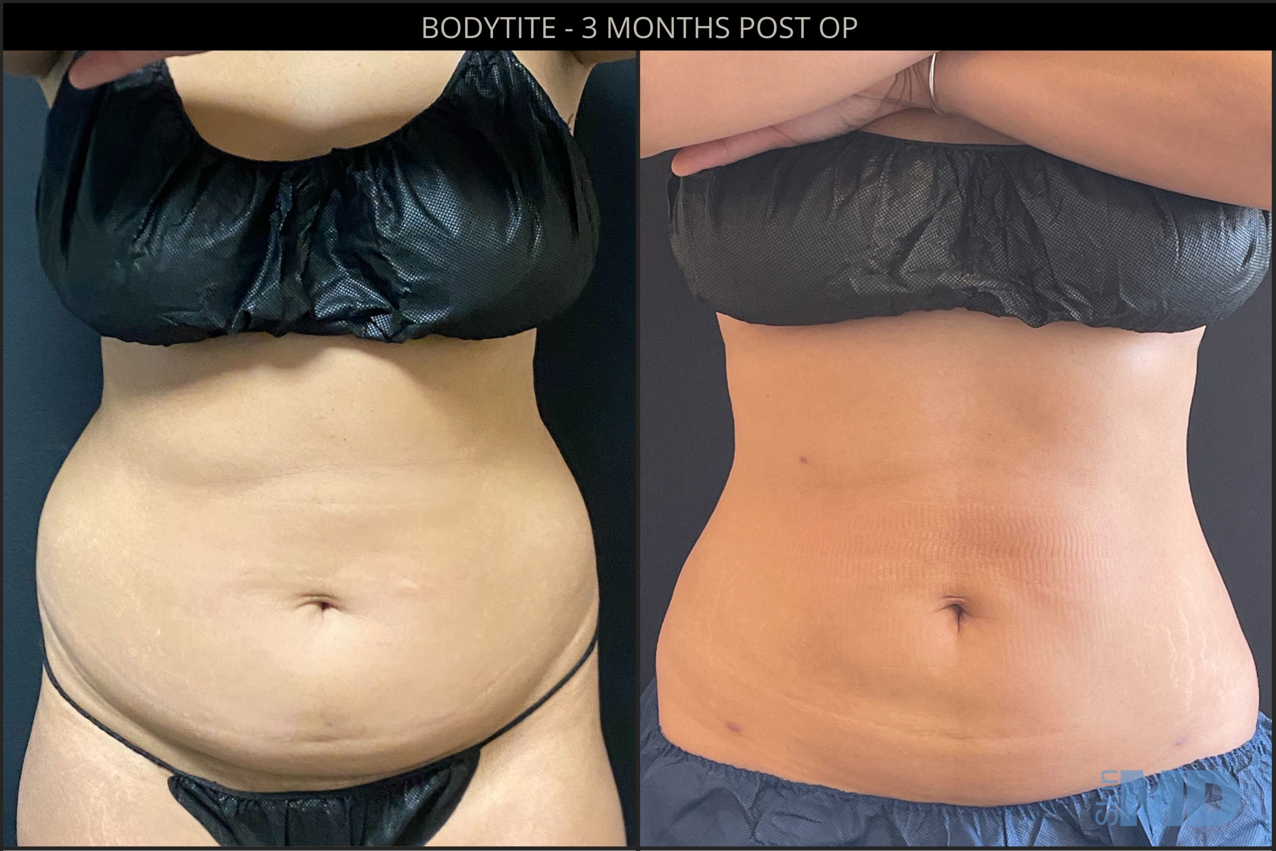 bodytite procedure