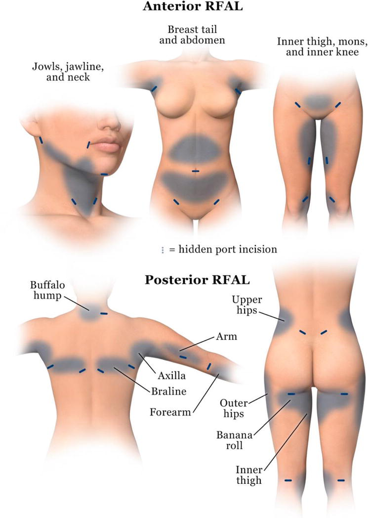 bodytite procedure