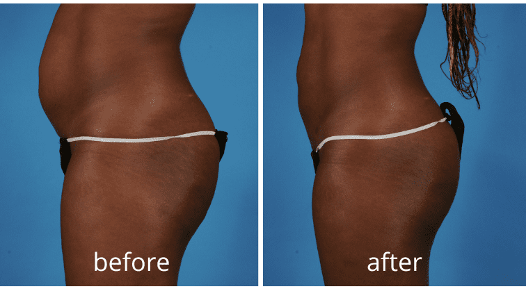 BodyTite Procedure: Innovative contouring solutions