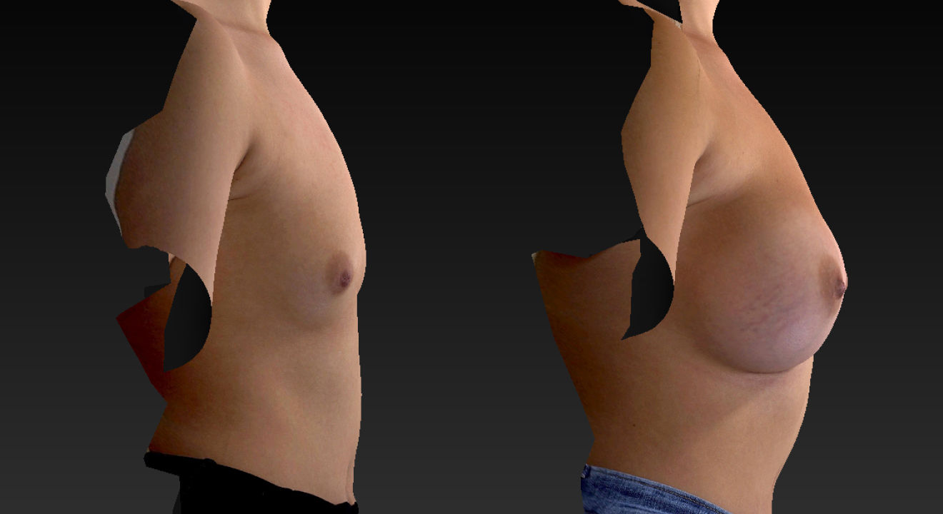 boob augmentation boob augmentation