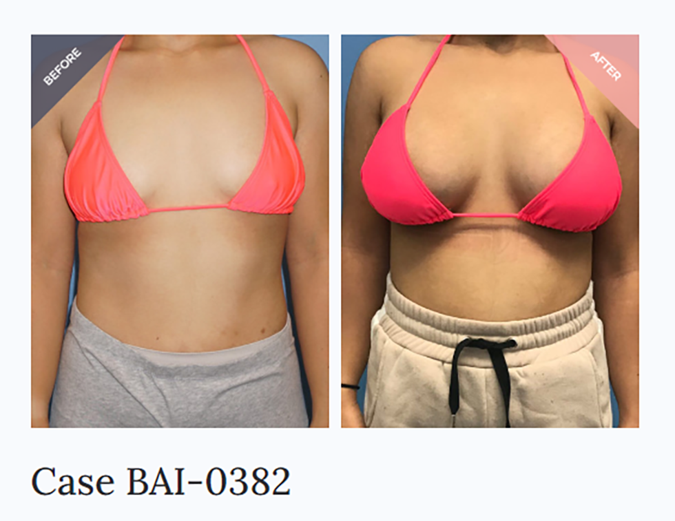 boob augmentation boob augmentation