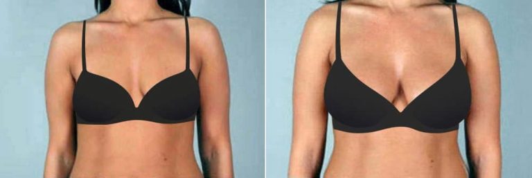 Boob job cost: How much should you expect to pay?