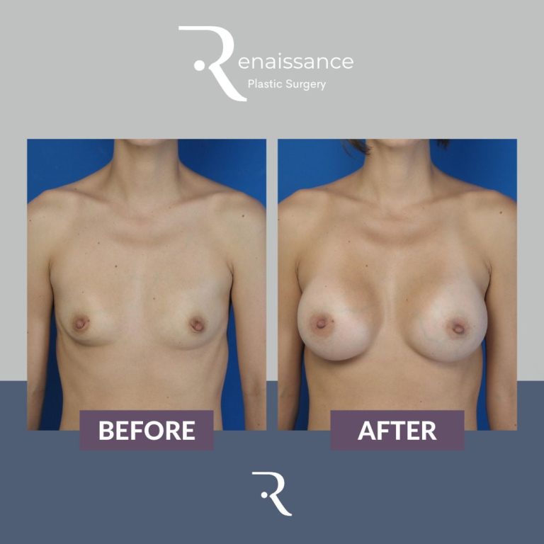 Boob job: Enhancing your figure with precision