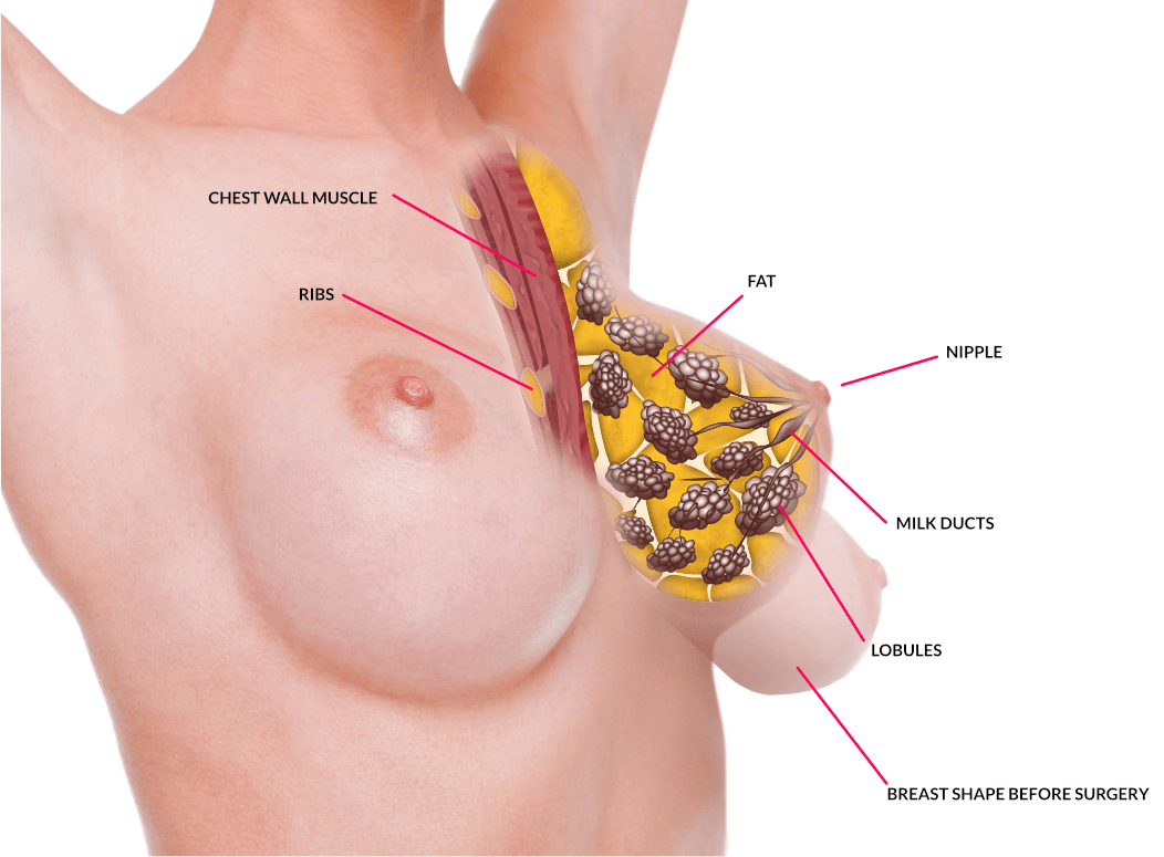 boob lift cost