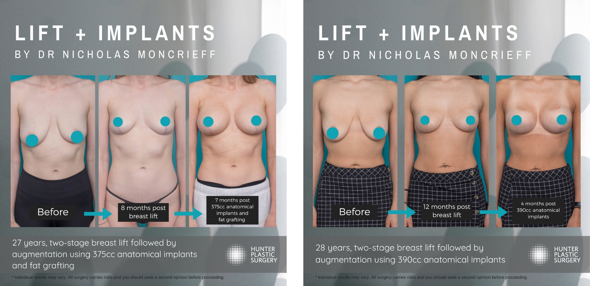 boob lift cost