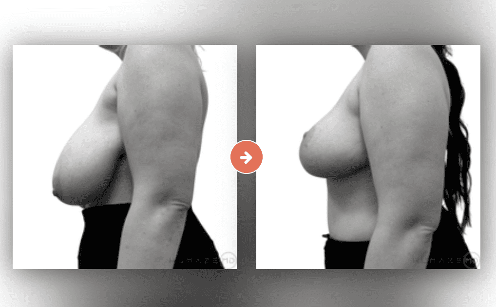 boob lift cost