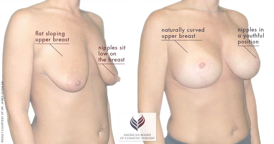boob lift boob lift