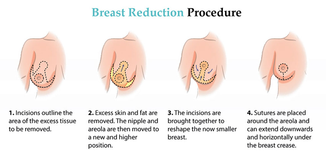 boob reduction price boob reduction price