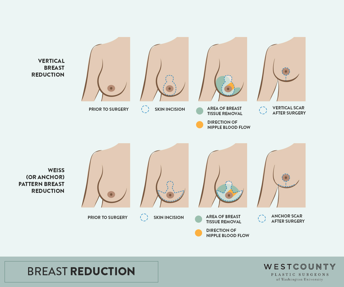 boob reduction price boob reduction price