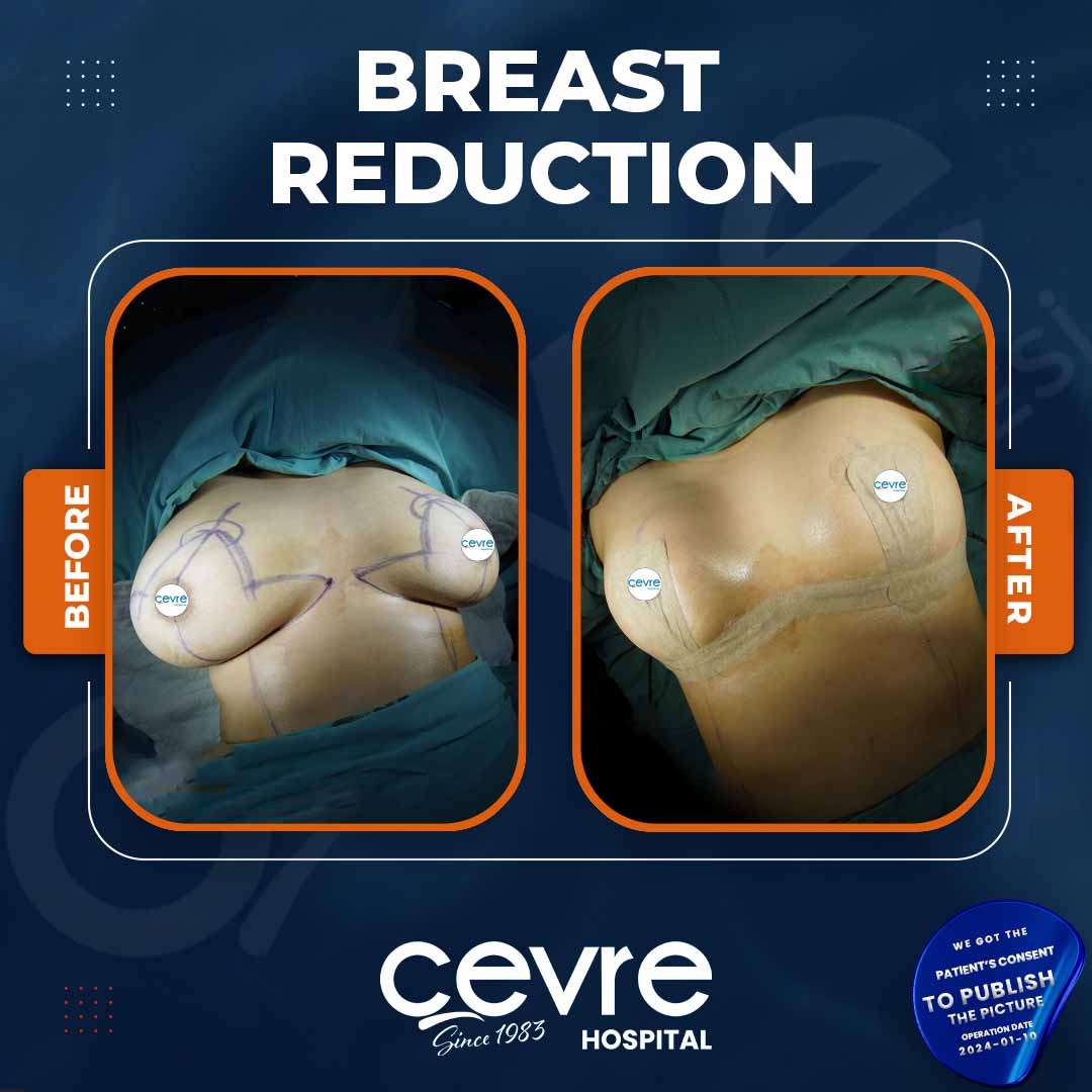 boob reduction price boob reduction price