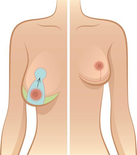 Boob reduction price: What to expect from the procedure