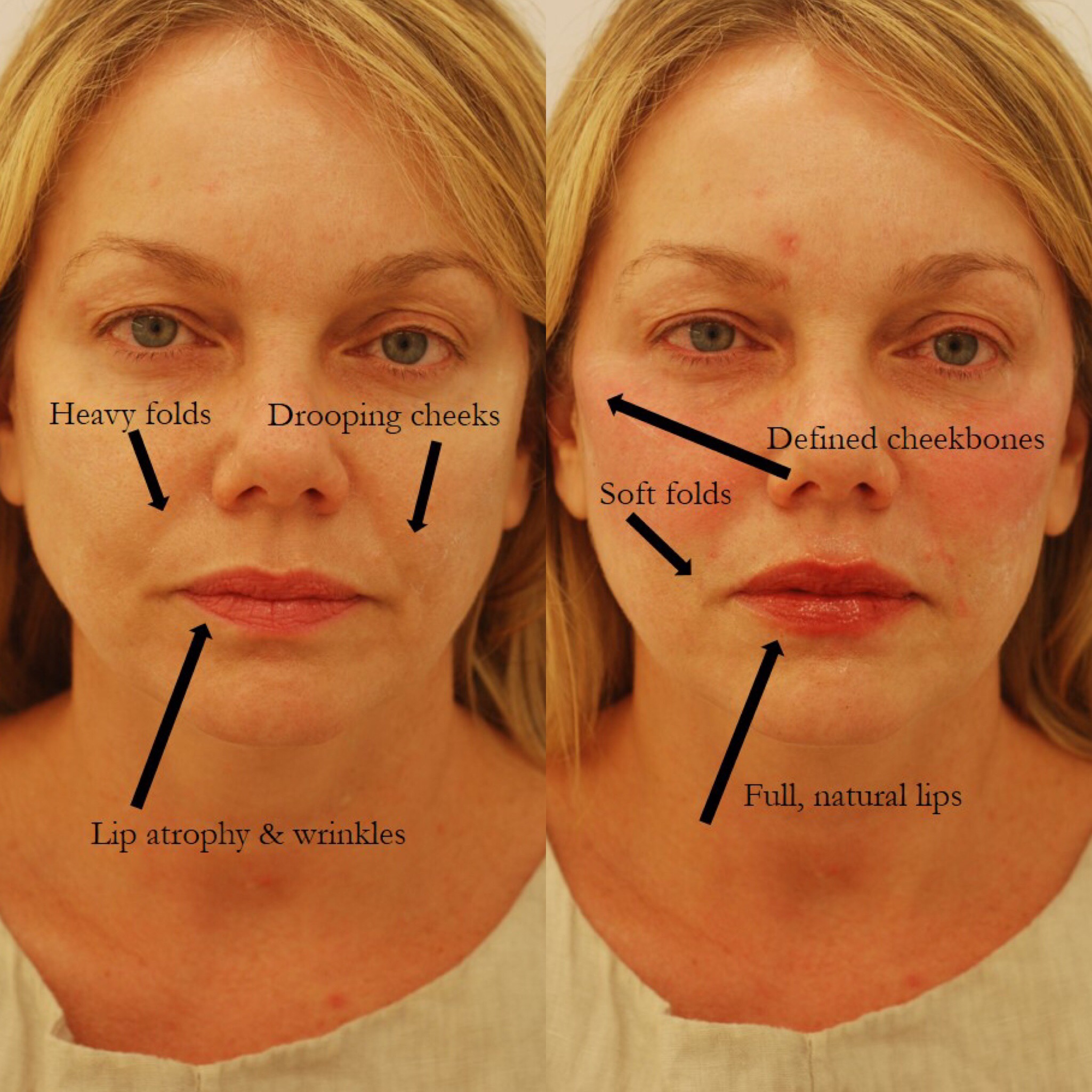 botox face lift botox face lift