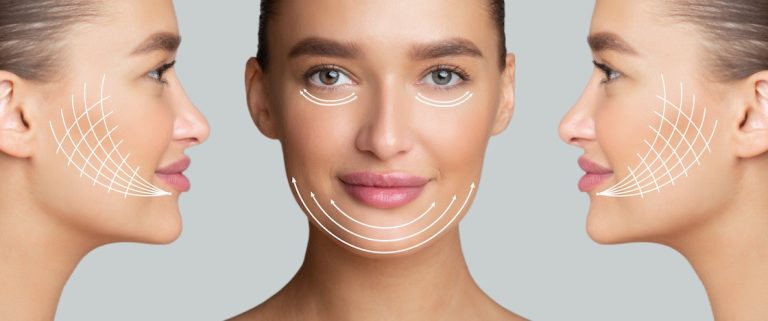 Botox Face Lift: Non-surgical rejuvenation