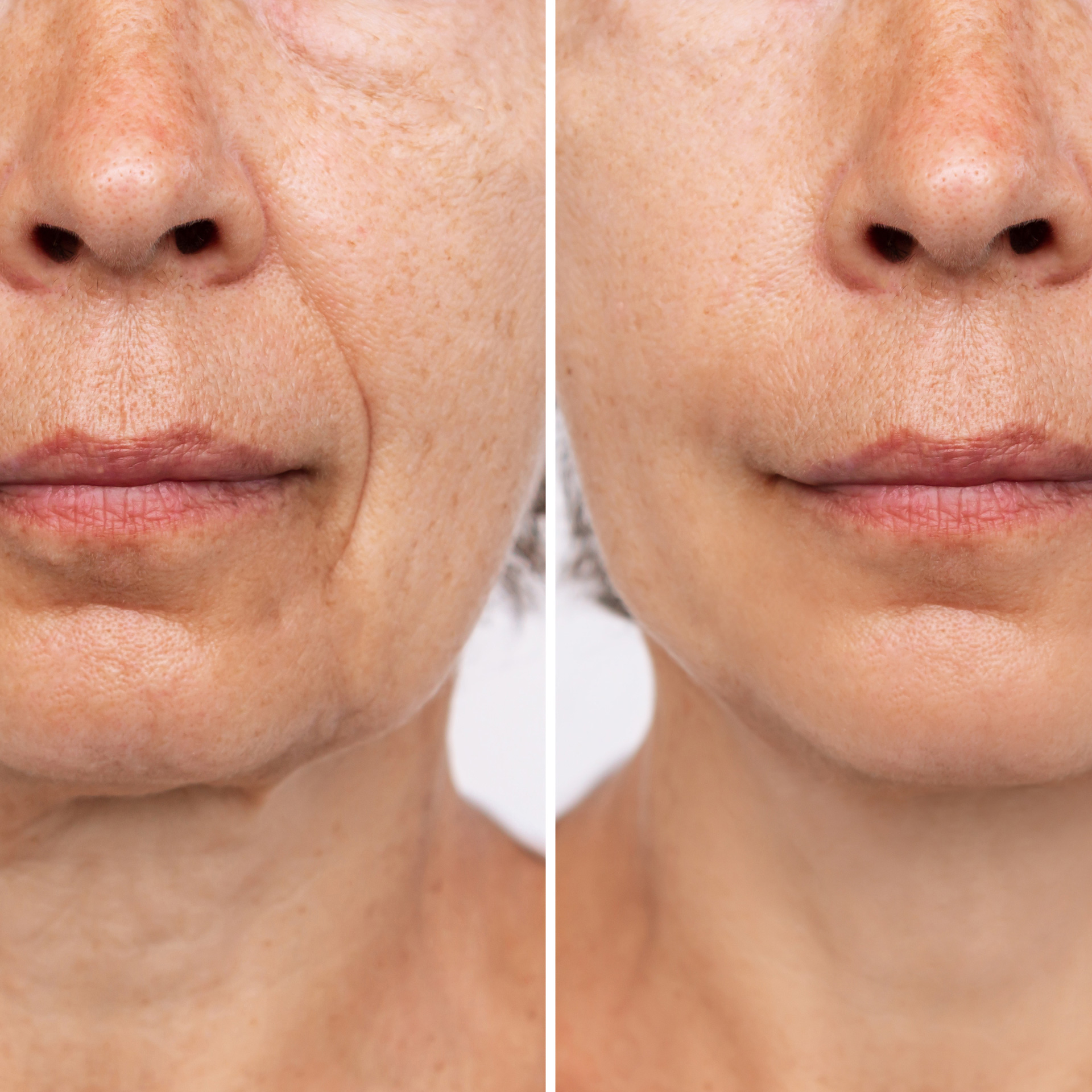 botox face lift botox face lift