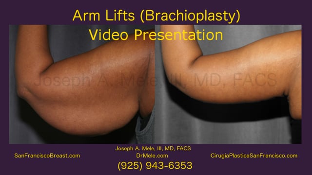 brachioplasty cost brachioplasty cost
