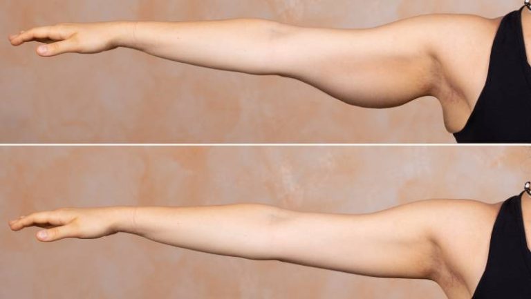 Brachioplasty cost: Budgeting for upper arm contouring