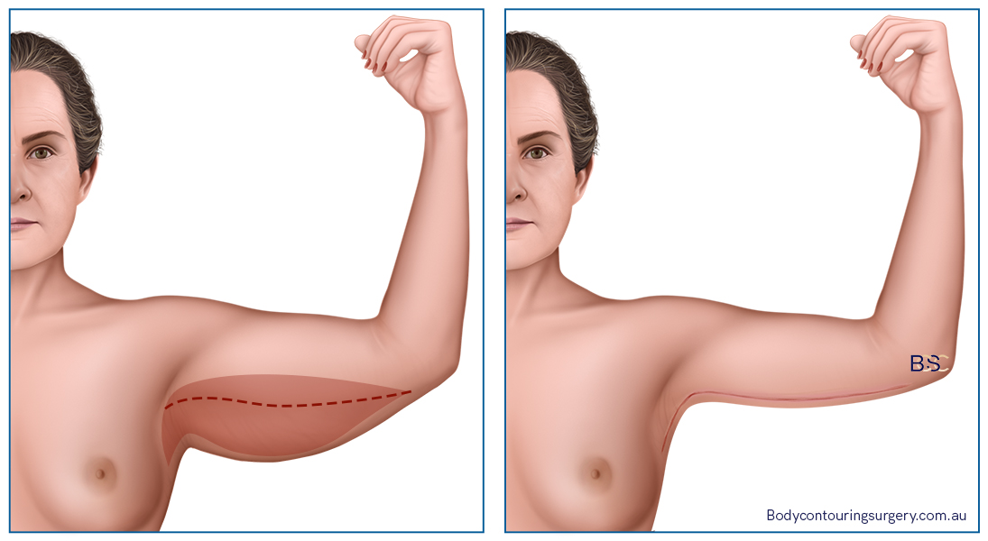brachioplasty cost brachioplasty cost