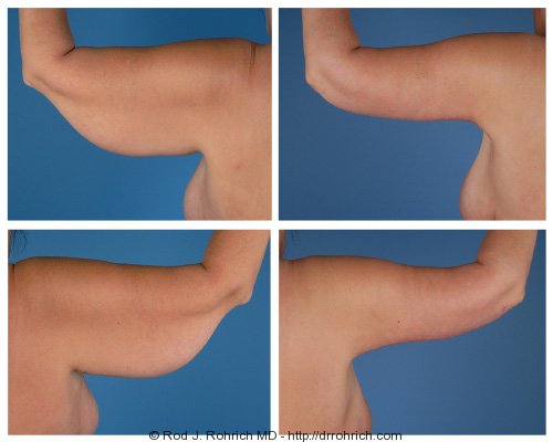 brachioplasty brachioplasty