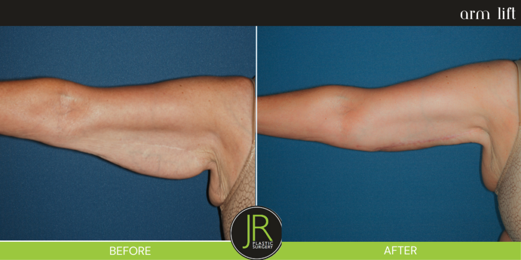 brachioplasty brachioplasty
