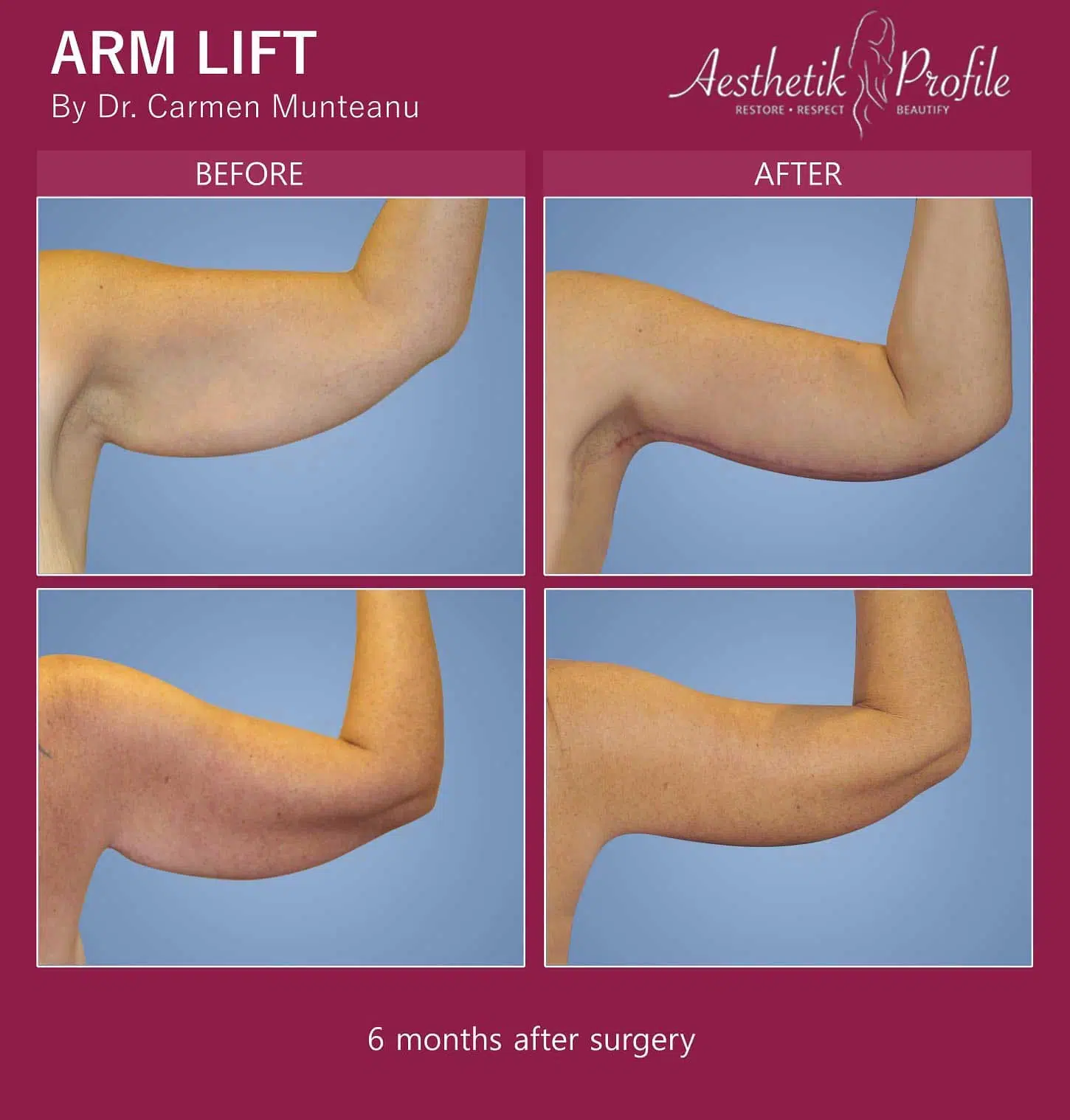 brachioplasty brachioplasty