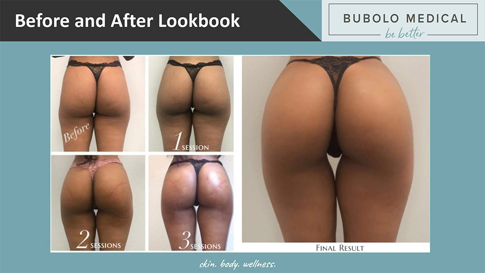 brazilian butt lift