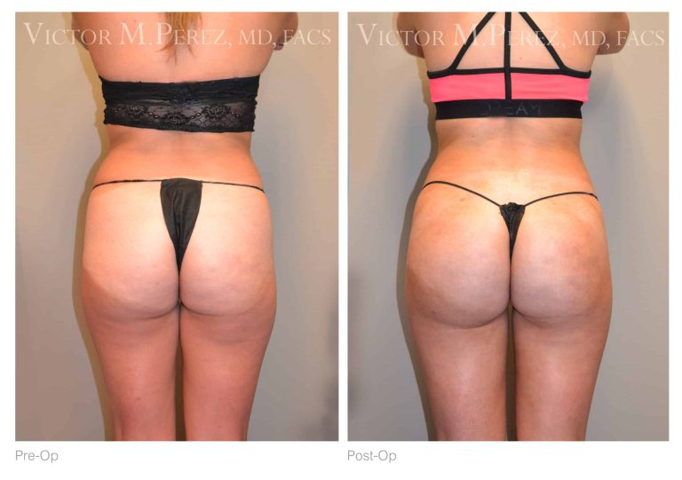 Brazilian butt lift: Enhancing curves with precision