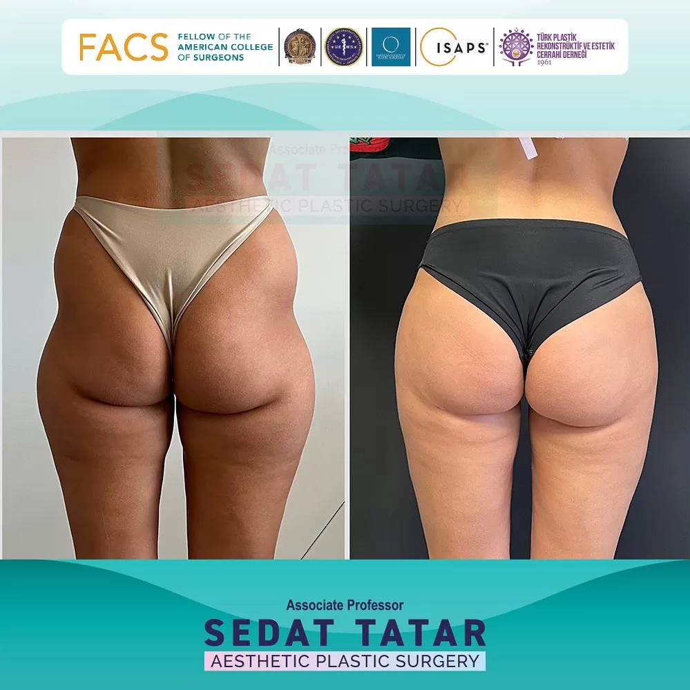 brazilian butt lift