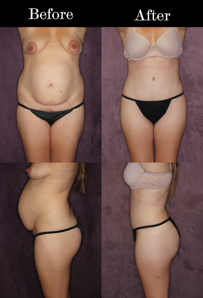 brazilian butt lift procedure brazilian butt lift procedure